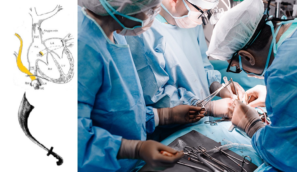 НМИЦ Мешалкина. Кардиохирург Тимур Хапаев в ходе операции 2.jpg НМИЦ Мешалкина. Кардиохирург Тимур Хапаев в ходе операции 2.jpg